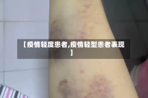 【疫情轻度患者,疫情轻型患者表现】