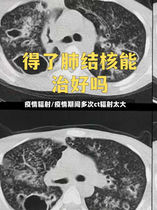 疫情辐射/疫情期间多次ct辐射太大-第1张图片