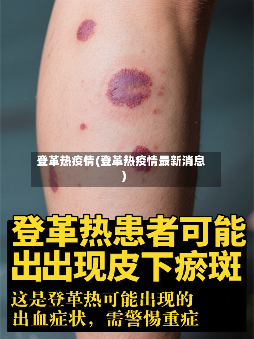 登革热疫情(登革热疫情最新消息)-第1张图片